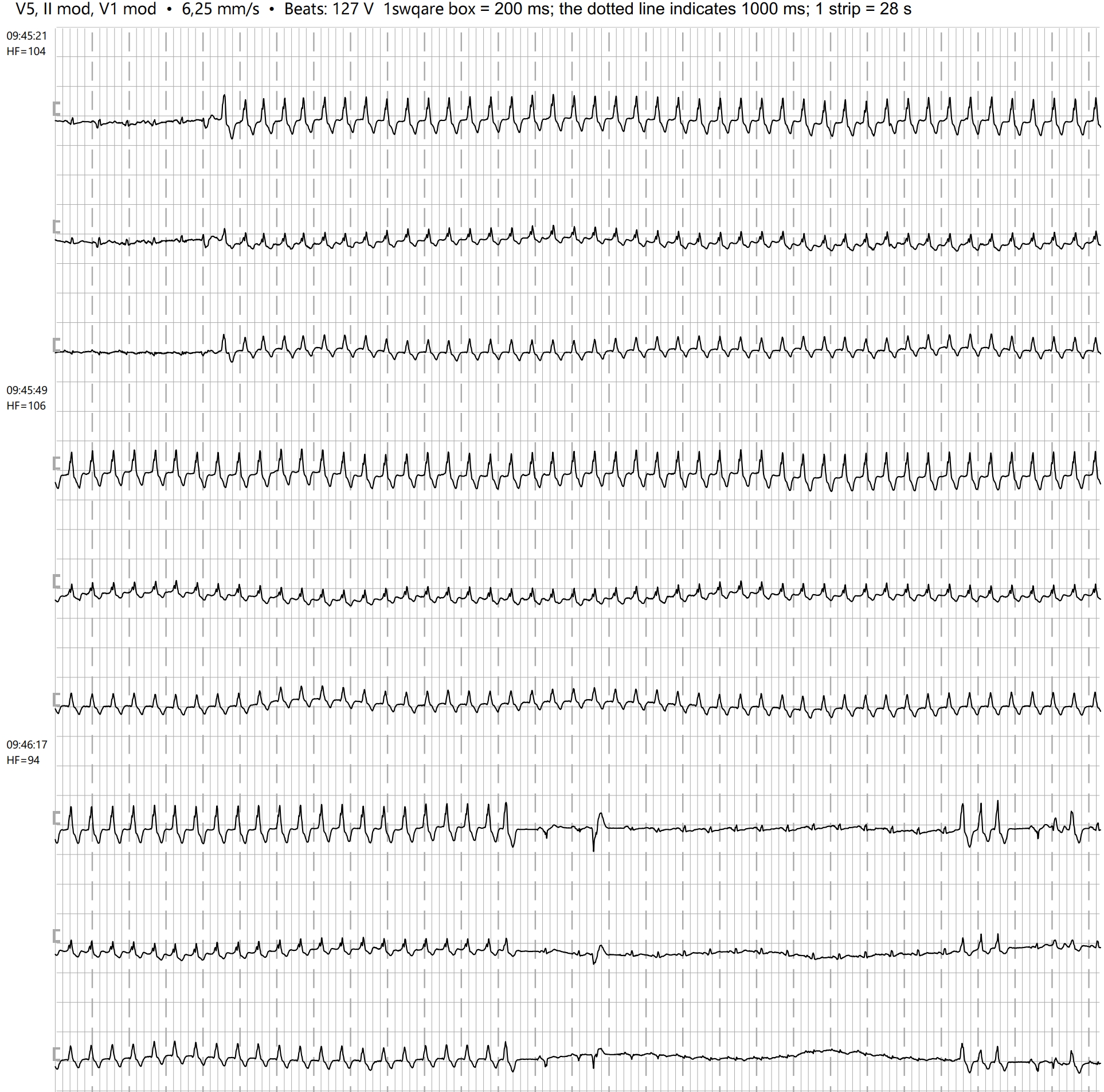 SUSTAINED VENTRICULAR TACHYCARDIA ECG Guru Instructor Resources